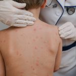 Campeche suma 17 casos de sarampión en medio de brote nacional